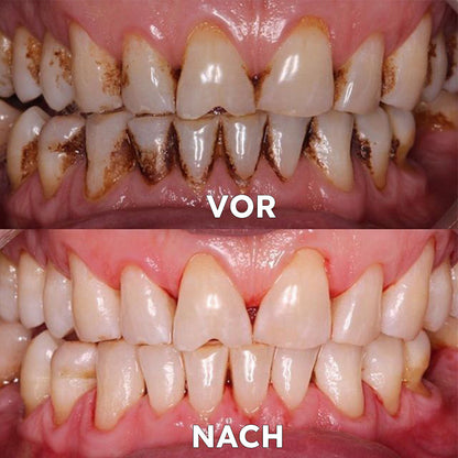 ✅Offizieller Shop | Ourlyard™ Zahnreparatur und Mundgesundheits-Mineralpulver🧑🏽‍⚕️Erhält die Zertifizierung der Deutschen Zahnärztekammer (Behandlung von Parodontitis und Mundgeschwüren, Vorbeugung von Zahnverlust und Behandlung von Karies)