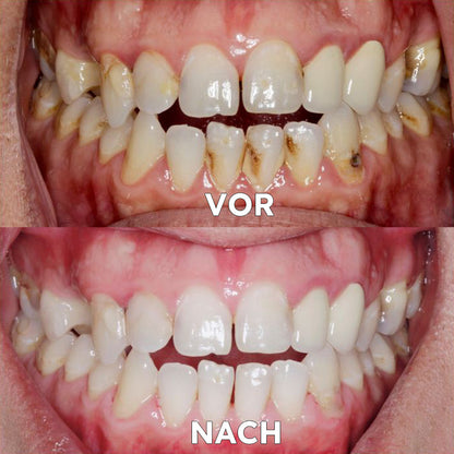 ✅Offizieller Shop | Ourlyard™ Zahnreparatur und Mundgesundheits-Mineralpulver🧑🏽‍⚕️Erhält die Zertifizierung der Deutschen Zahnärztekammer (Behandlung von Parodontitis und Mundgeschwüren, Vorbeugung von Zahnverlust und Behandlung von Karies)